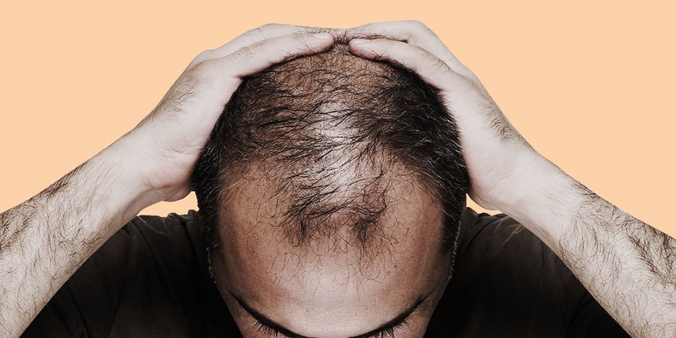 6 دلیل که باعث ریزش مو می شود