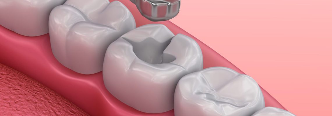 بررسی بهترین آمالگام های دندانی
