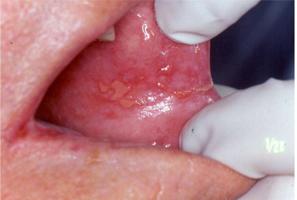 موکوزیت دهان یا التهاب بافت های دهان