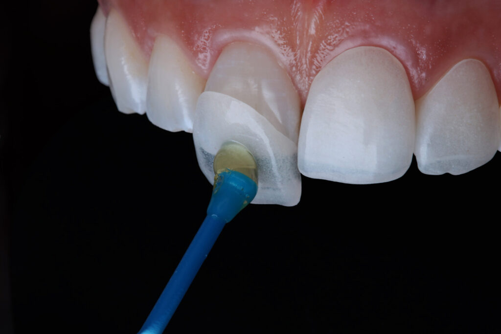 دندان سرامیکی چیست؟ چگونه انجام می شود؟ انواع آن چیست؟