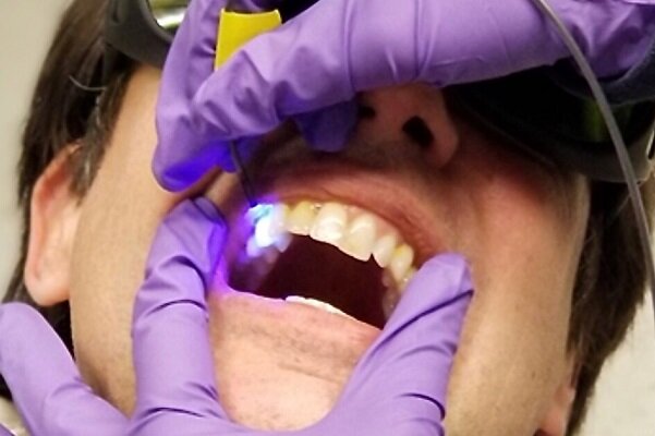 پوسیدگی دندان بیماری شایع در کودکان و بزرگ‌سالان