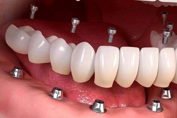 آیا برندهای چینی برای ایمپلنت دندان قابل اعتماد هستند؟