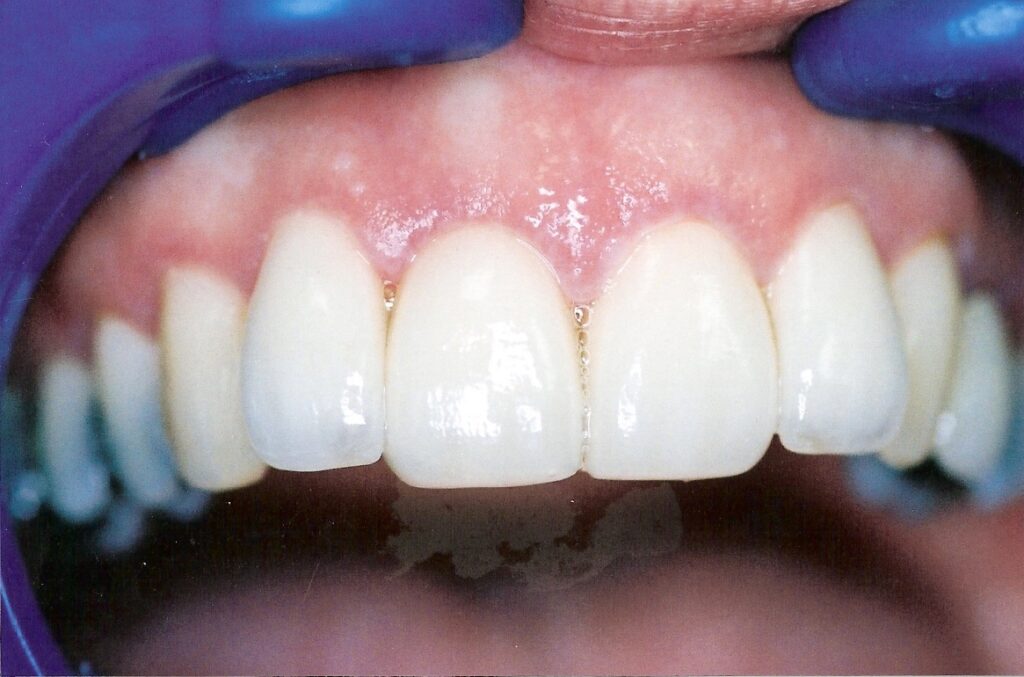 آیا بعد از درمان ریشه نیاز به روکش دندانی وجود دارد؟