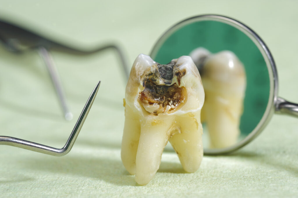 پوسیدگی های دندانی و درمان آن