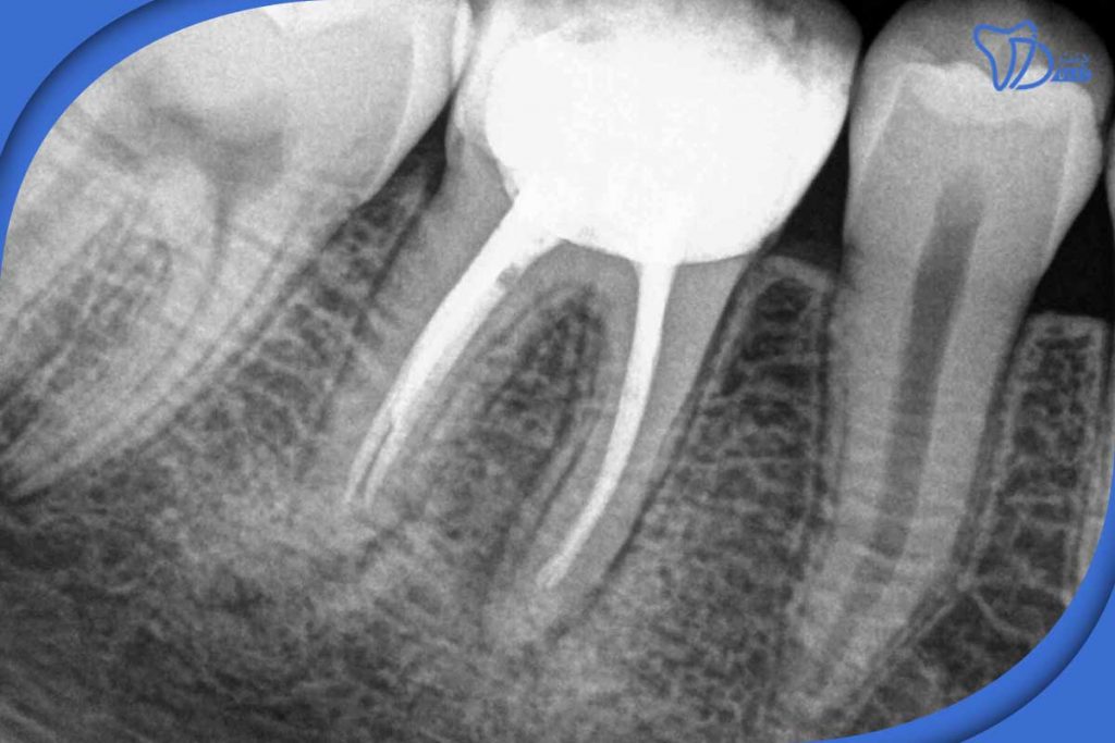 وضعیت دندان پس از کانال ریشه