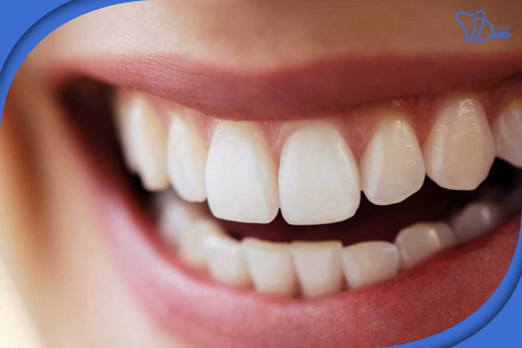 درمان سفید کردن دندان