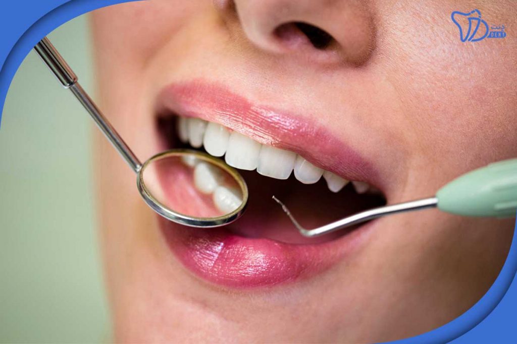 درمان تارتار دندان با نانوآنزیم