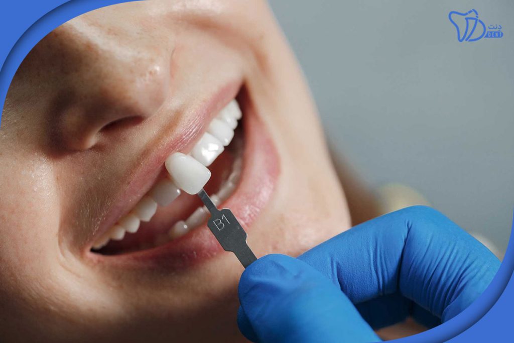 7 علت افتادن روکش دندان + درمان موقت در خانه