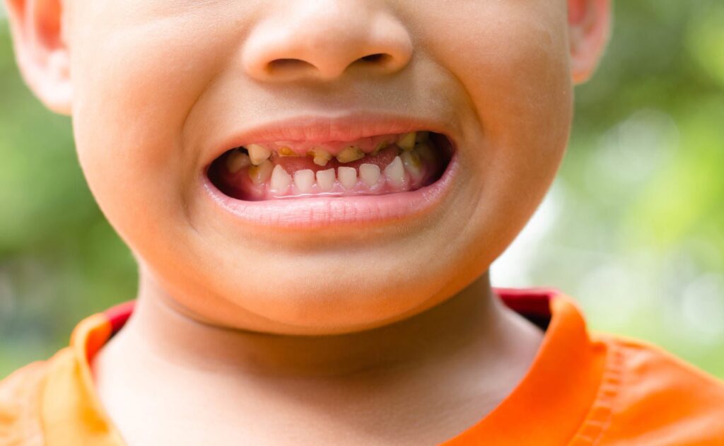 9 روش مختلف برای جلوگیری از پوسیدگی دندان