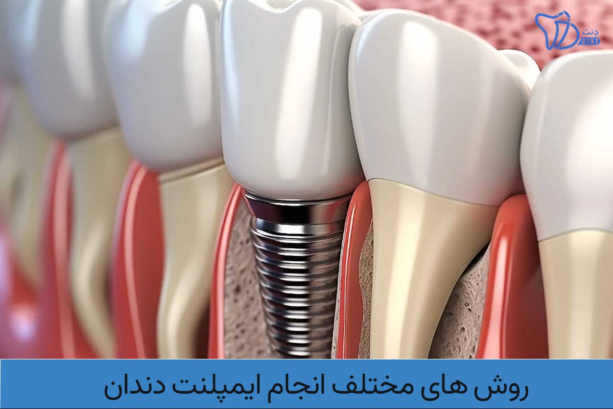 روش های مختلف انجام ایمپلنت دندان