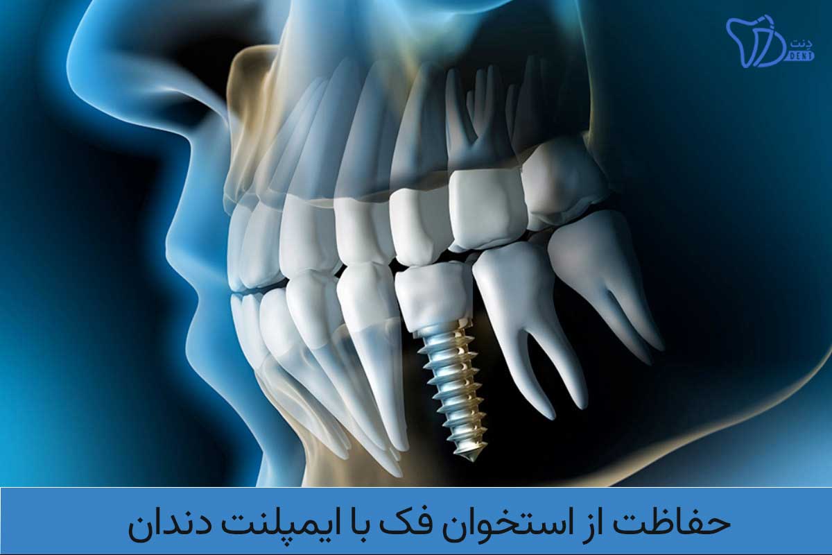 حفاظت از استخوان فک با ایمپلنت دندان