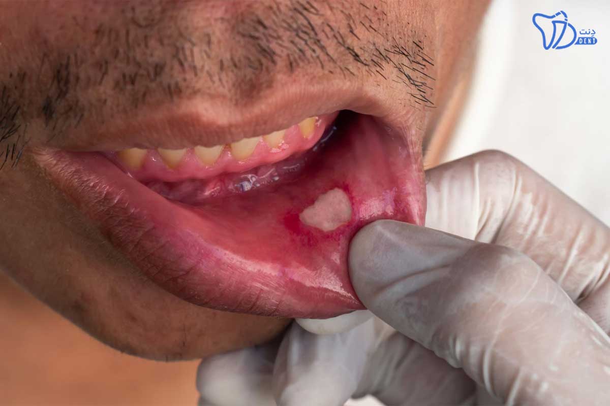 پیشگیری از زخم زبان
