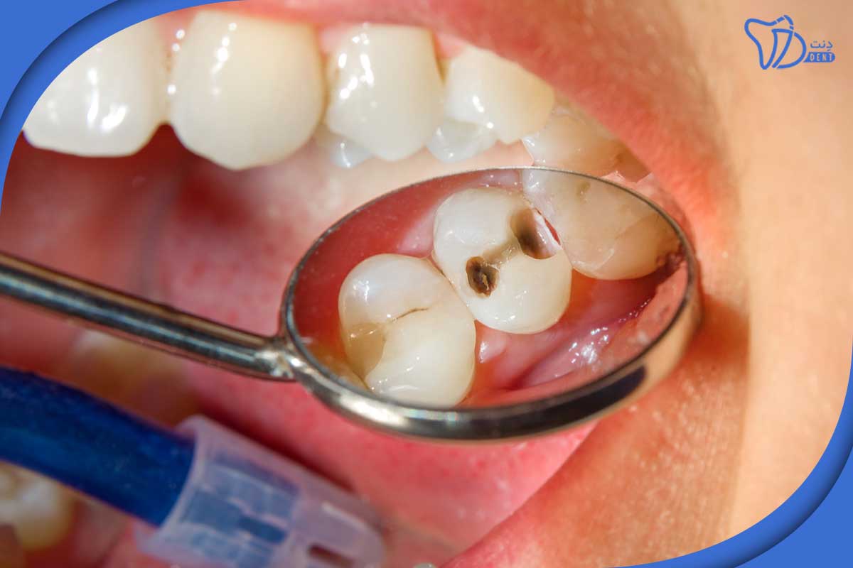دلیل خراب شدن دندان از ریشه