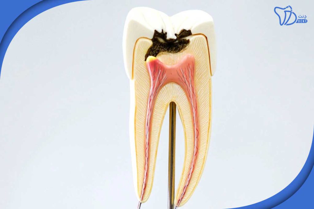 خراب شدن دندان از ریشه
