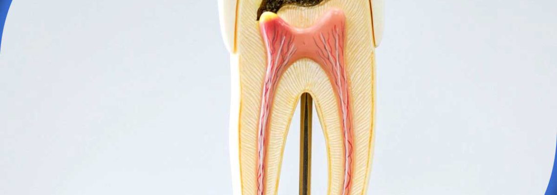دلیل خراب شدن دندان از ریشه چیست؟