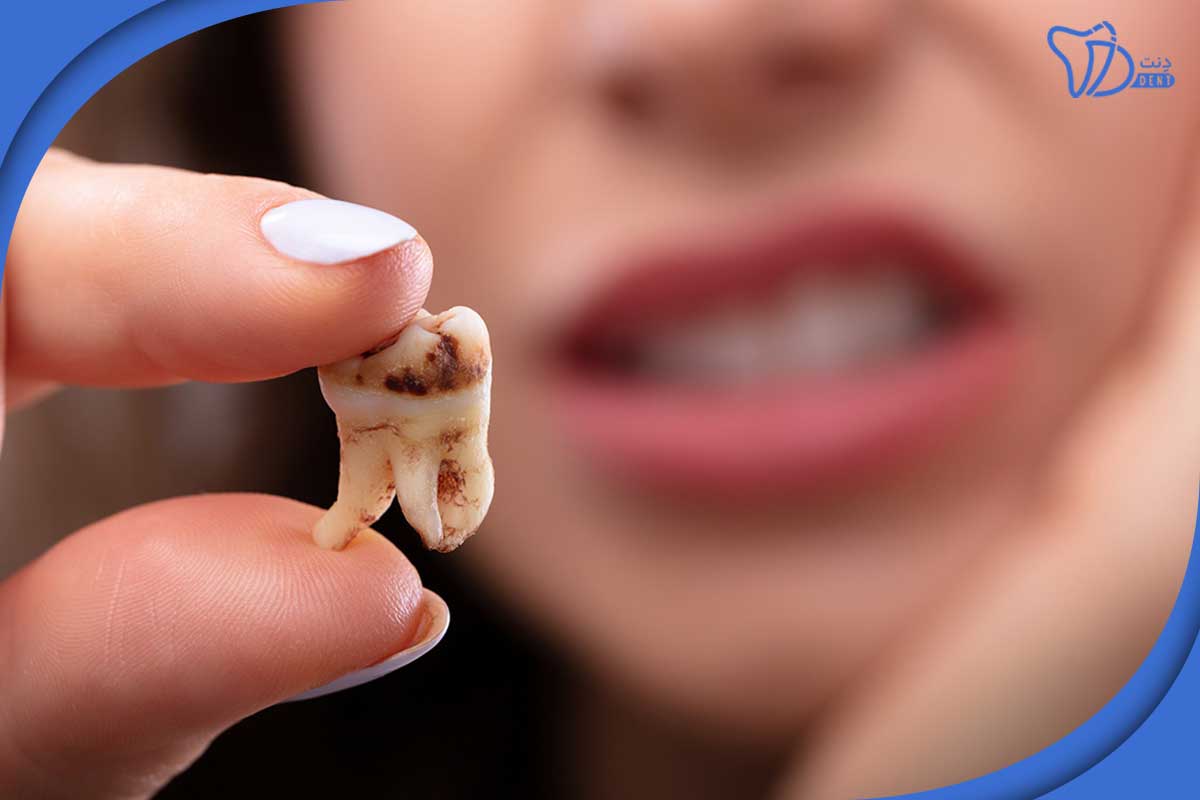 پوسیدگی دندان از ریشه 