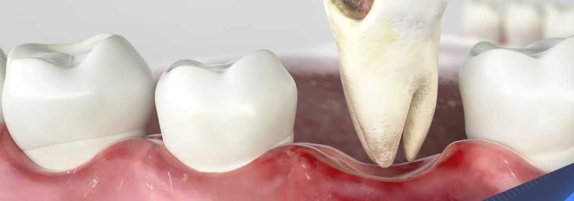 بافت سفید در ناحیه دندان کشیده شده