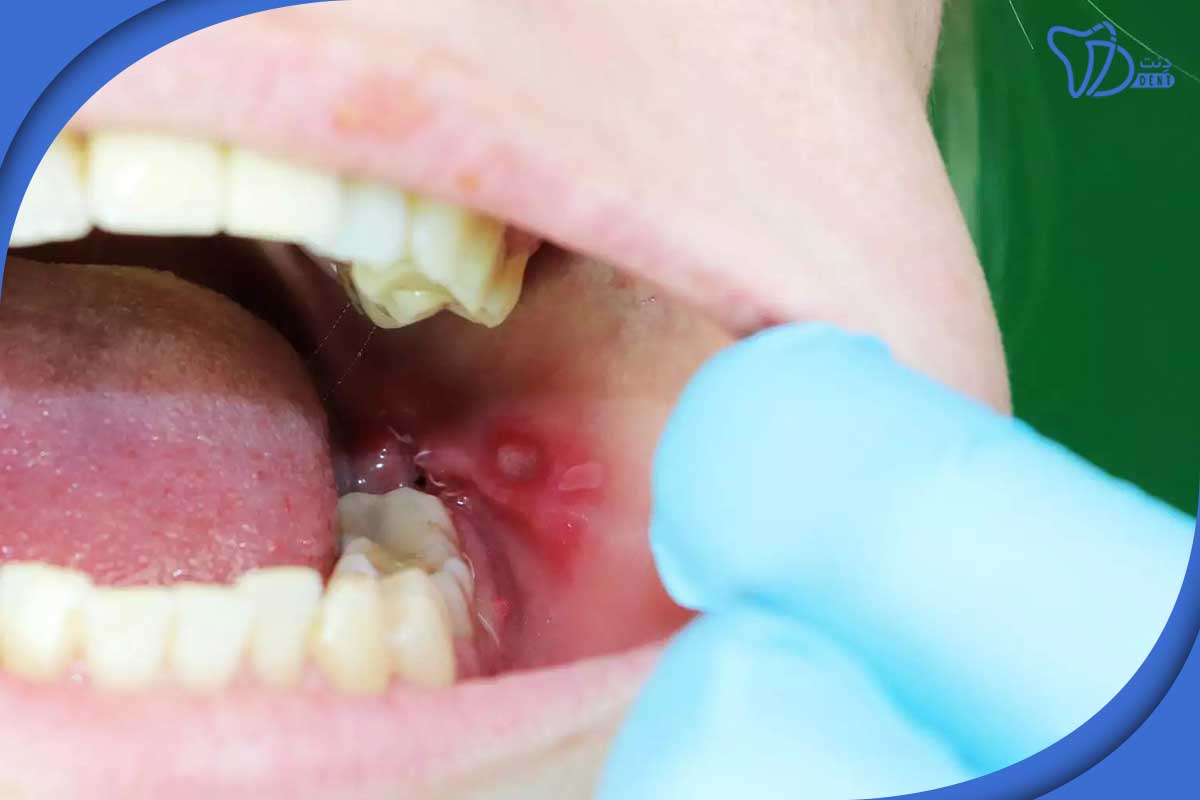 درمان زخم زبان ناشی از تیزی دندان