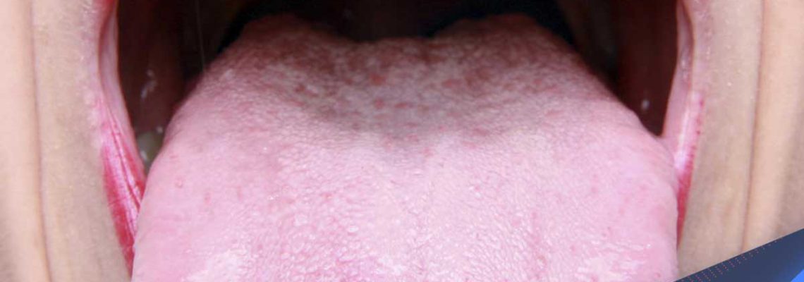 علت لخته خون دهان چیست؟