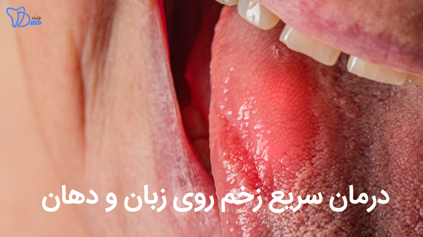 درمان سریع زخم دهان