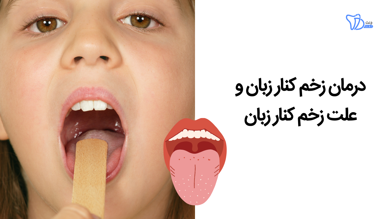 درمان زخم کنار زبان و علت زخم کنار زبان